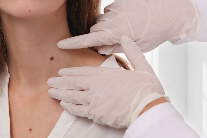 Skin Tag Removal